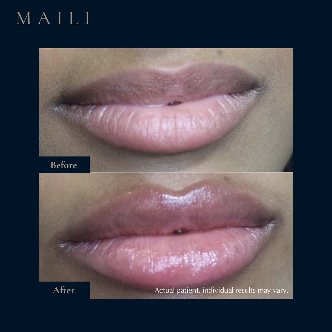 Lip Enhancement by Aestha Clinic
