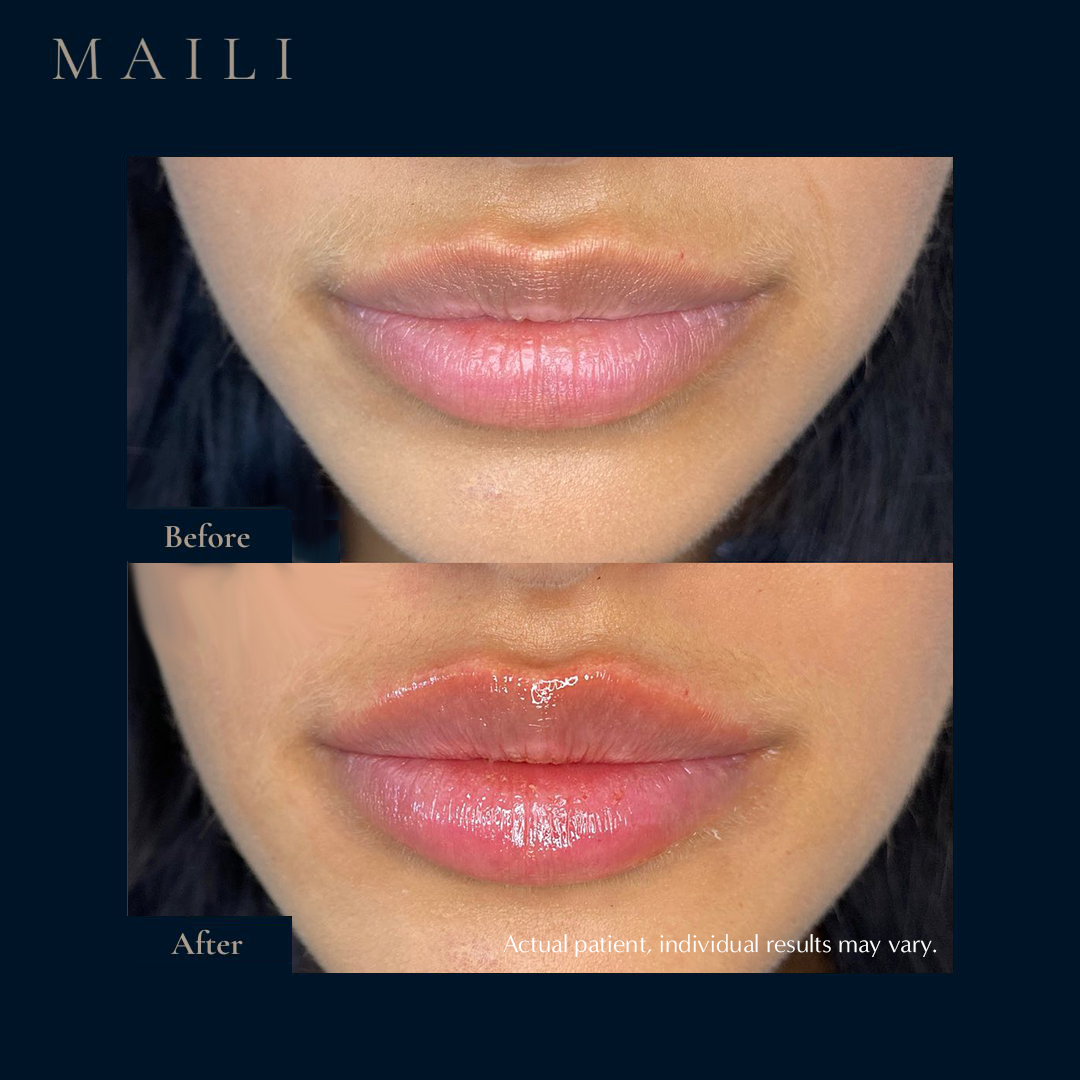 Lip Enhancement by Number One Aesthetics