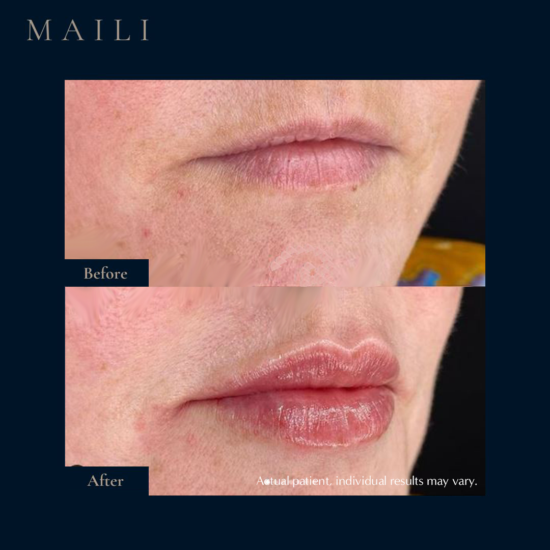 Lip Enhancement by Dr. Natalie Ball